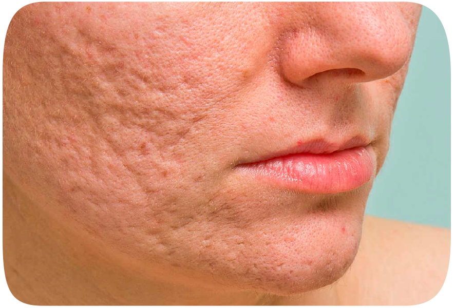 Revisión de cicatrices